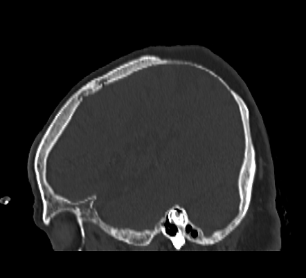 Biparietal Osteodystrophy (thinning Of Parietal Bones) | Image ...