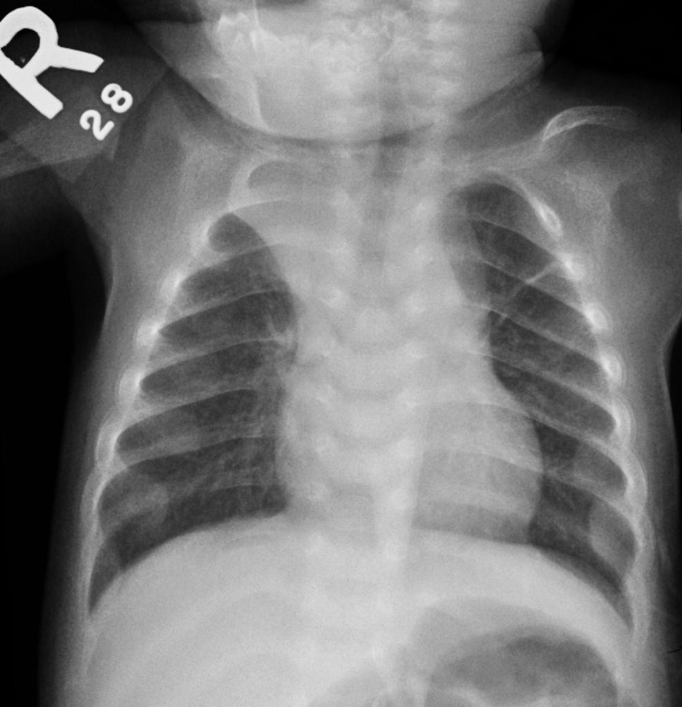 Rickets Radiology Case Radiopaedia Org