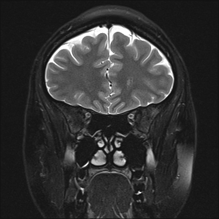 CSF leak and intracranial hypertension | Radiology Case | Radiopaedia.org