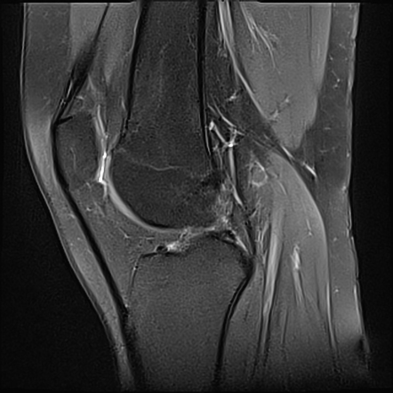 Patellar tendon-lateral femoral condyle friction syndrome | Radiology ...