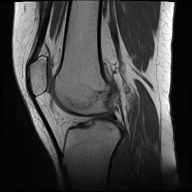 Patellar Tendon-lateral Femoral Condyle Friction Syndrome 