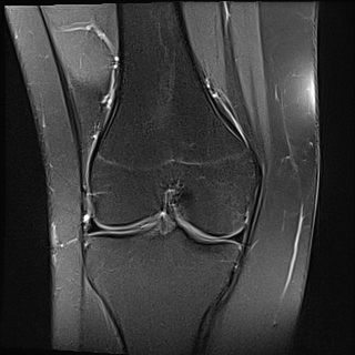 Patellar tendon-lateral femoral condyle friction syndrome | Image ...