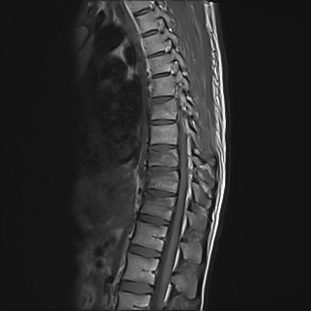 Spinal Compression Fracture 