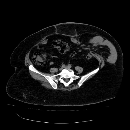 Lumbar incisional hernia | Radiology Case | Radiopaedia.org