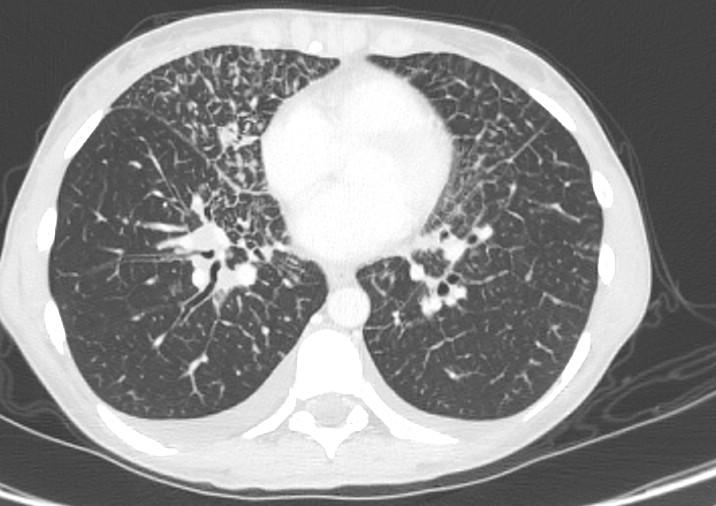 ALK-positive anaplastic large cell lymphoma | Image | Radiopaedia.org