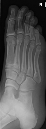 Plastic bowing fracture of the 5th metatarsal | Radiology Case ...