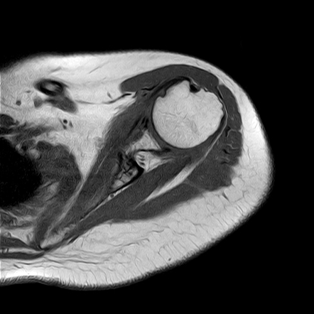 Adhesive Capsulitis Of The Shoulder | Radiology Case | Radiopaedia.org