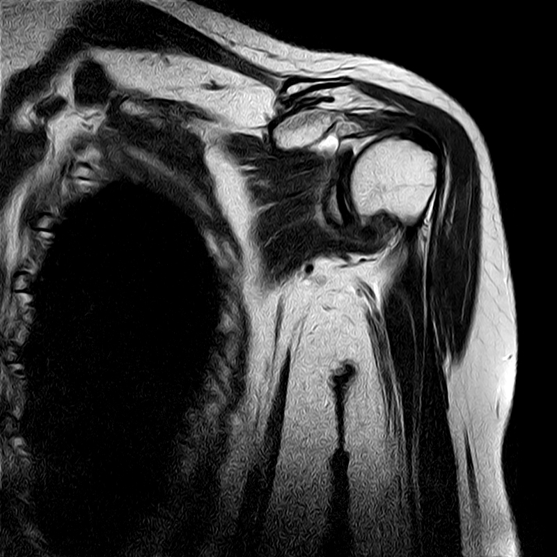 Adhesive capsulitis of the shoulder Image