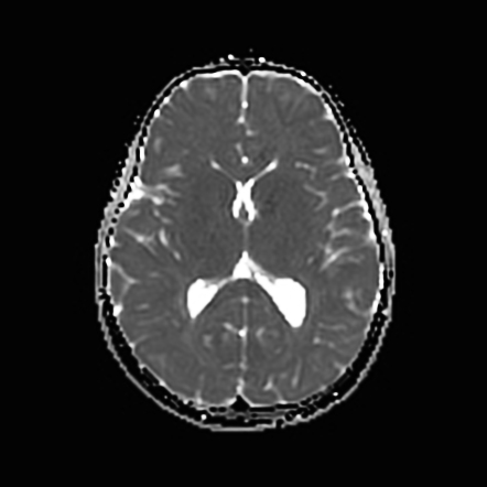 Subependymal nodular gray matter heterotopia | Image | Radiopaedia.org