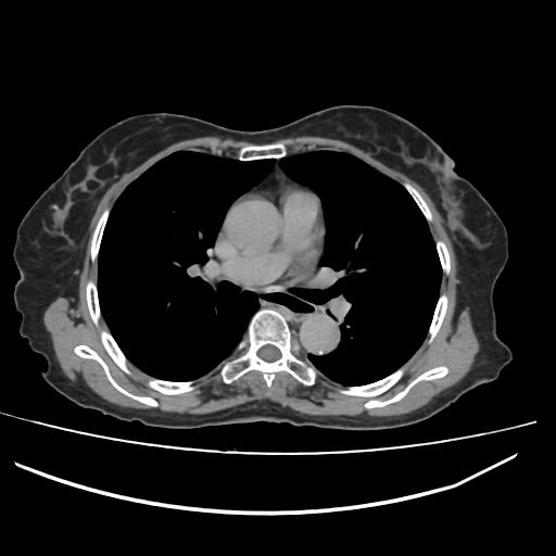 Epiphrenic diverticulum | Image | Radiopaedia.org