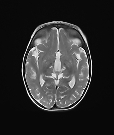 Biotin-thiamine-responsive Basal Ganglia Disease | Image | Radiopaedia.org