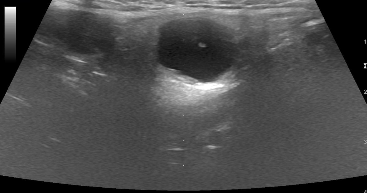 First Branchial Cleft Cyst Image 4165