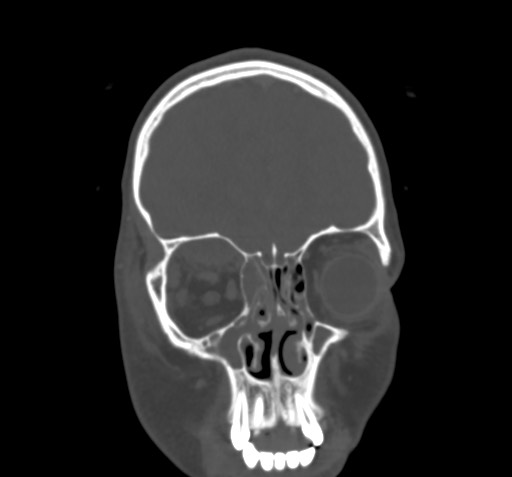 Orbital Cellulitis Image