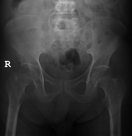 Amyloid arthropathy and myopathy, mimicking osteomyelitis with ...