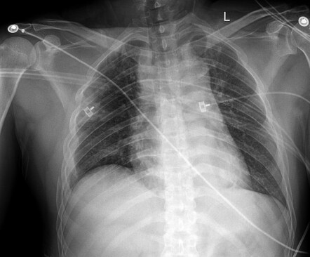 Traumatic aortic injury with repair | Radiology Case | Radiopaedia.org