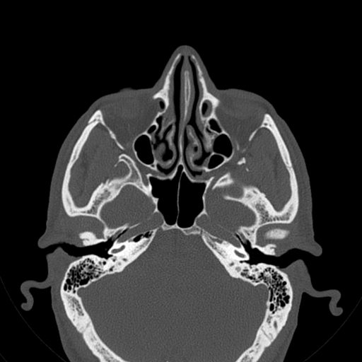 Paradoxical rotation of the middle turbinates | Image | Radiopaedia.org