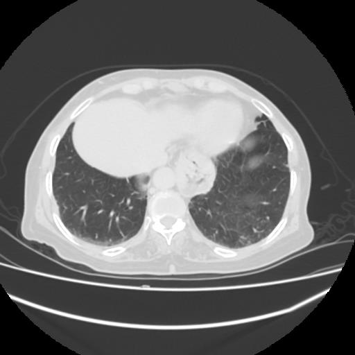 Epiphrenic diverticulum | Image | Radiopaedia.org