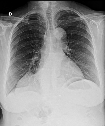 Epiphrenic diverticulum | Radiology Case | Radiopaedia.org