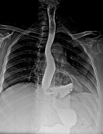 Mixed Hiatus Hernia Radiology Case Radiopaedia Org