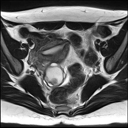 Ovarian endometrioma - T2 dark spot sign | Image | Radiopaedia.org