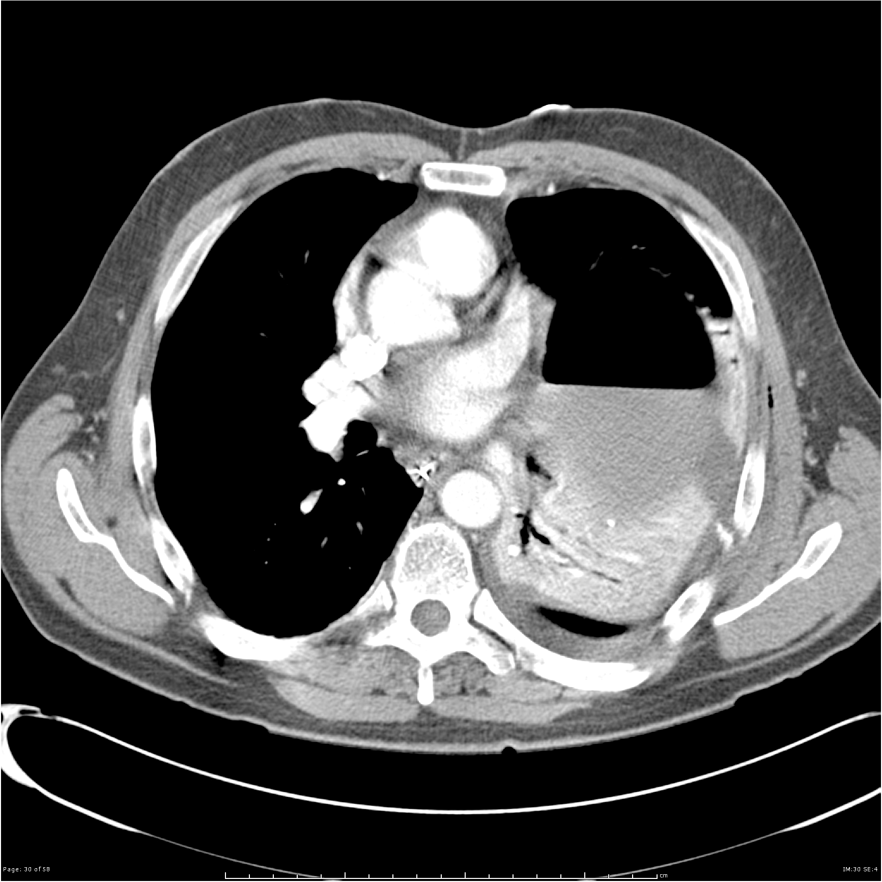 Traumatic diaphragmatic rupture | Image | Radiopaedia.org