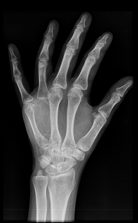 Aneurysmal bone cyst of the 4th metacarpal bone | Image | Radiopaedia.org