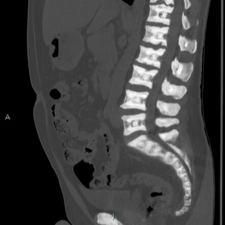 Osteopetrosis | Radiology Case | Radiopaedia.org