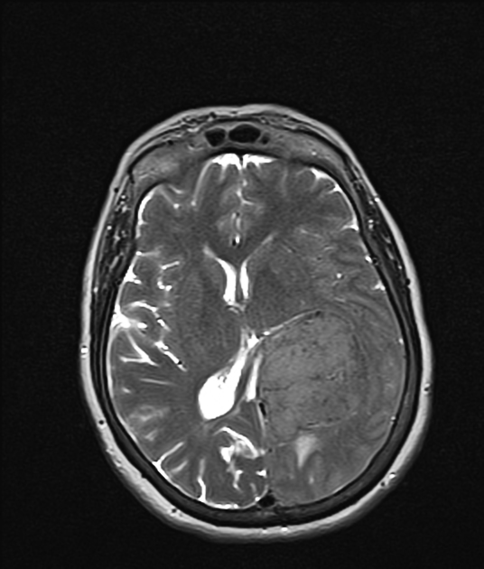 Meningioma | Radiology Case | Radiopaedia.org