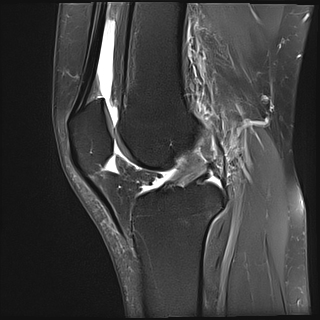 Anterior cruciate ligament partial tear | Image | Radiopaedia.org