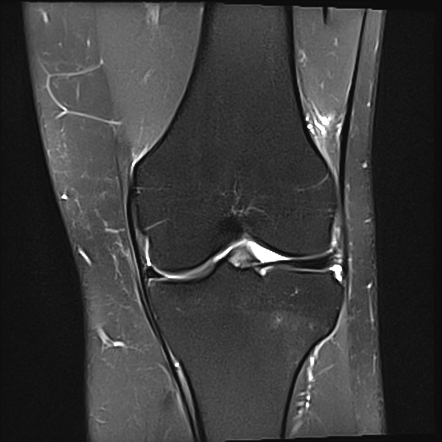 Anterior cruciate ligament partial tear | Image | Radiopaedia.org