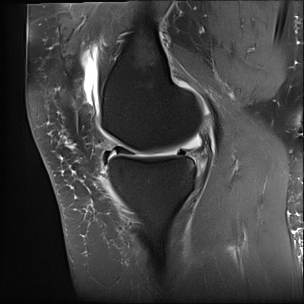 Double delta sign (meniscal tear) | Radiology Reference Article ...