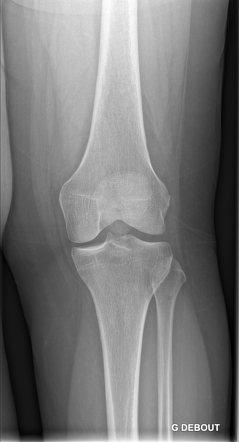 Bucket handle meniscal tear | Radiology Case | Radiopaedia.org