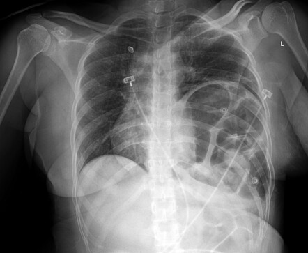 Diaphragm rupture | Radiology Case | Radiopaedia.org