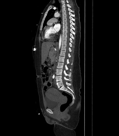 Diaphragm rupture | Image | Radiopaedia.org