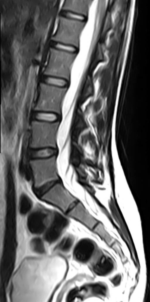 Disc sequestration | Image | Radiopaedia.org