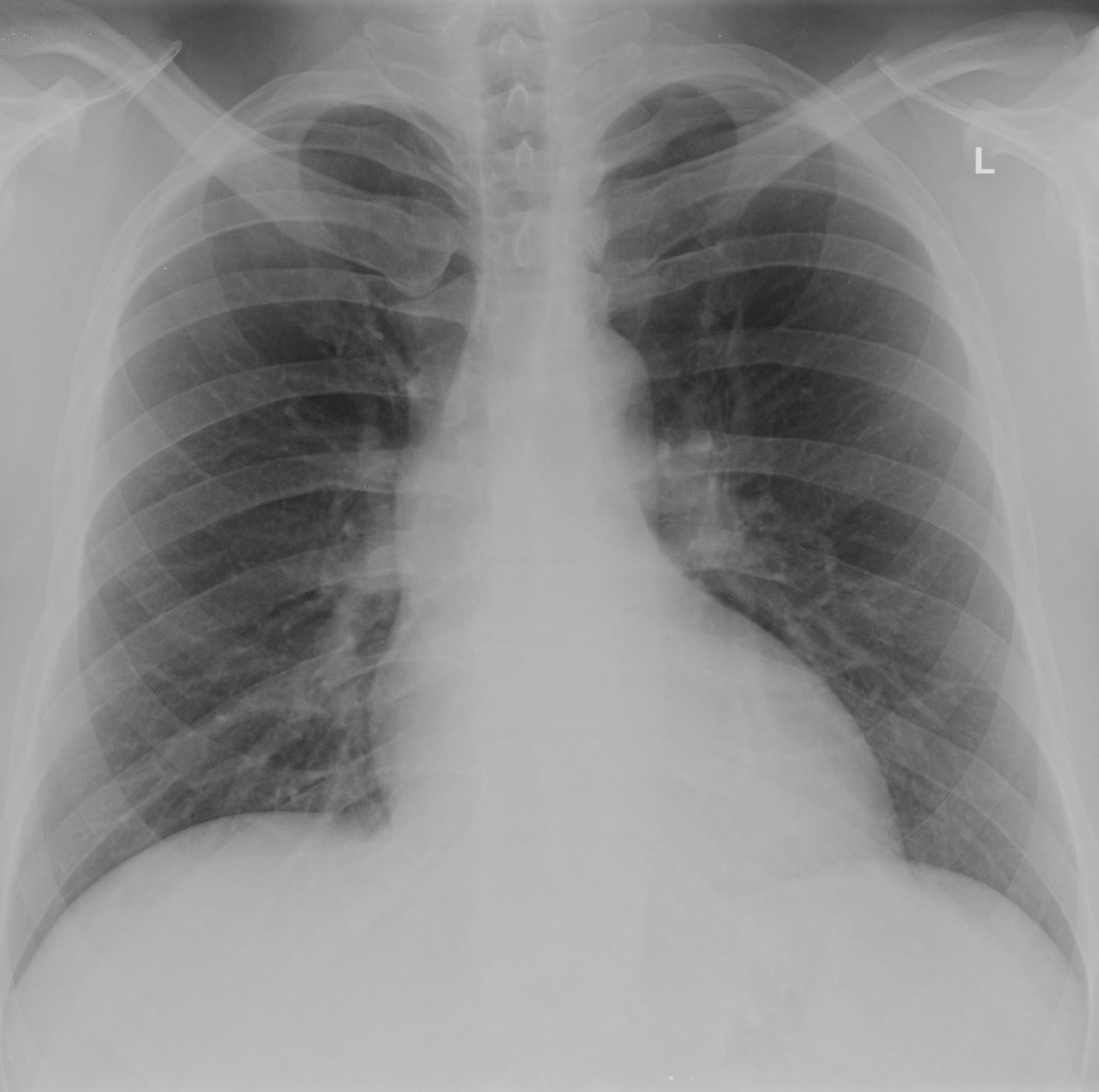 Cardiomegaly (mild) | Image | Radiopaedia.org