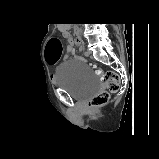 Obturator Hernia Image 