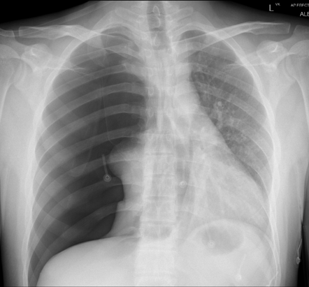 Tension Pneumothorax Radiology Case Radiopaedia Org