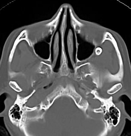 Ectopic tooth - infratemporal fossa | Image | Radiopaedia.org