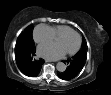 Cardiomegaly | Radiology Reference Article | Radiopaedia.org