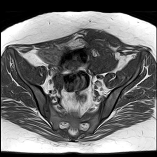 Tubo Ovarian Abscess Following Cesarian Section Image 0977