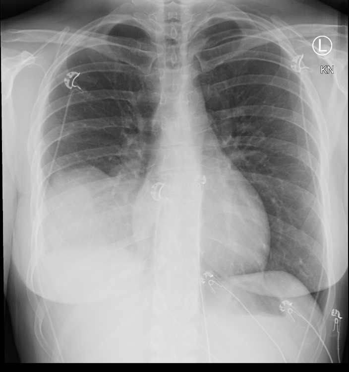 Pulmonary blastoma | Image | Radiopaedia.org