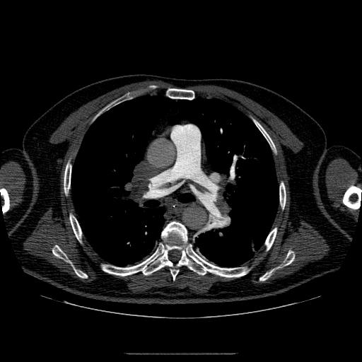 Saddle Pulmonary Embolism Image 6991