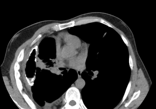 trapped-lung-image-radiopaedia