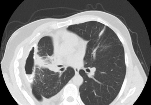 pdf-pneumothorax-ex-vacuo-or-trapped-lungs-appearing-as-iatrogenic