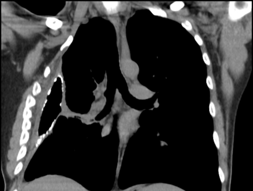 fibrosis-an-overlooked-companion-of-inflammation-archive