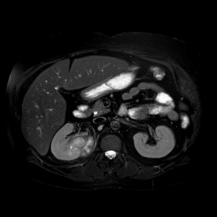 Acute and chronic pyelonephritis with renal abscess | Radiology Case ...