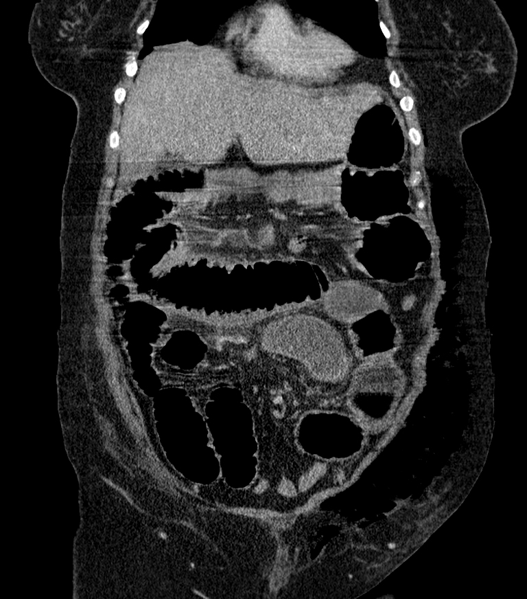 Perforated Incarcerated Incisional Hernia Image Radiopaedia Org