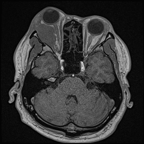 IgG4-related orbital disease mimicking orbital lymphoma | Image ...