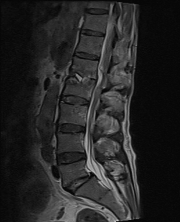 Spondylodiscitis | Radiology Case | Radiopaedia.org